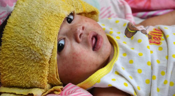 Hong Kong Health Authorities Investigate Imported Measles Case